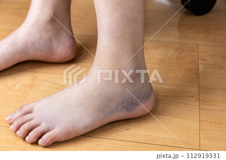 ねん挫した足首 112919331