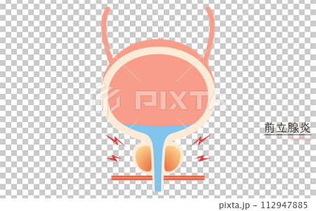 Medical illustration of prostate, prostatitis 112947885