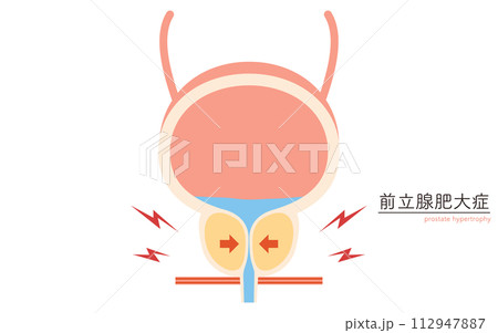 前立腺肥大症の医療イラスト、正常な前立腺と肥大した前立腺の比較 112947887