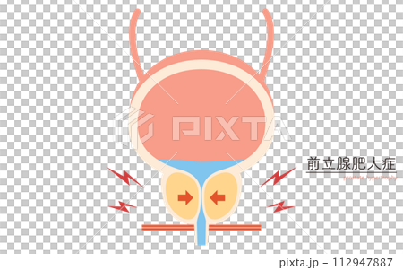 前立腺肥大症の医療イラスト、正常な前立腺と肥大した前立腺の比較 112947887