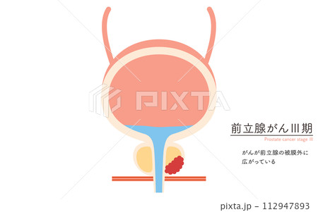 前立腺の医療イラスト、前立腺癌のステージ3 前立腺の医療イラスト、前立腺癌のステージ3 112947893