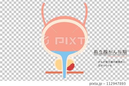 前立腺の医療イラスト、前立腺癌のステージ3 前立腺の医療イラスト、前立腺癌のステージ3 112947893