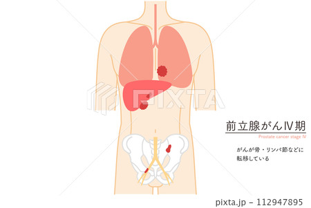 前立腺の医療イラスト、前立腺癌のステージ4 前立腺の医療イラスト、前立腺癌のステージ4 112947895