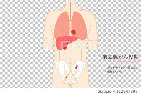 前立腺の医療イラスト、前立腺癌のステージ4 前立腺の医療イラスト、前立腺癌のステージ4 112947895