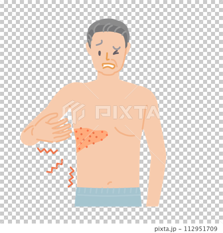 Shingles: Senior man with pain, itching, and swelling from chest to back 112951709