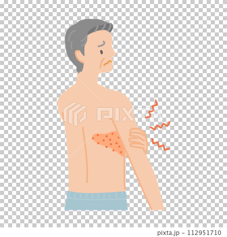 帶狀皰疹:老人從背部到胸部疼痛、搔癢和腫脹(後視圖) 帶狀皰疹:老人從背部到胸部疼痛、搔癢和腫脹(後視圖) 112951710