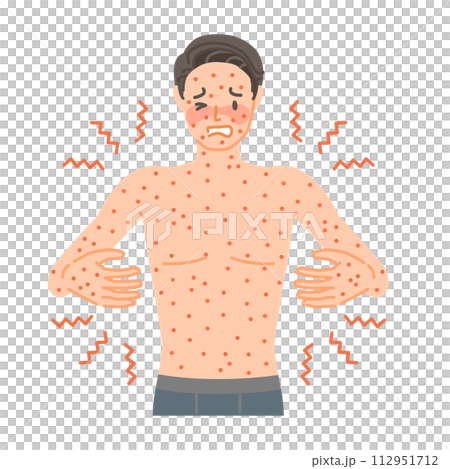 皮疹:一名男子因蕁麻疹而全身搔癢、疼痛。 皮疹:一名男子因蕁麻疹而全身搔癢、疼痛。 112951712