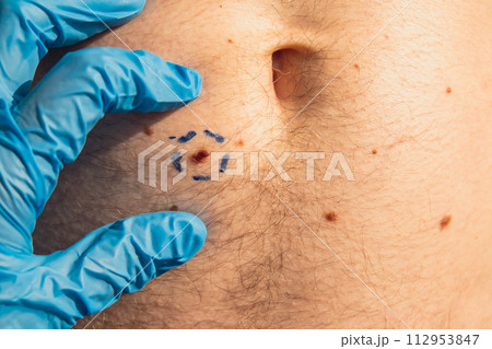 Doctor in medical gloves paint lines around male birthmarks. Preparing procedure for medical surgery. Laser skin tags removal. Prevention of melanoma 112953847
