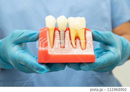 Dental implant, artificial tooth roots into jaw, root canal of dental treatment, gum disease, teeth model for dentist studying about dentistry. 112968902