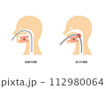 胃カメラ　経鼻内視鏡　経口内視鏡 112980064