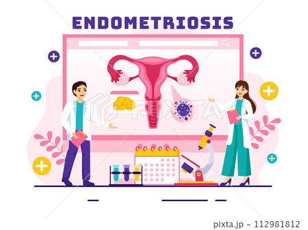 Endometriosis Vector Illustration with Condition the Endometrium Grows Outside the Uterine Wall in Women for Treatment in Flat Cartoon Background 112981812