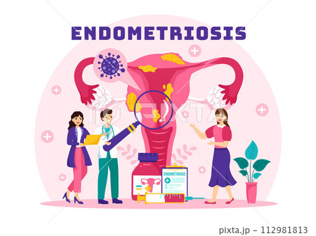 Endometriosis Vector Illustration with Condition the Endometrium Grows Outside the Uterine Wall in Women for Treatment in Flat Cartoon Background 112981813