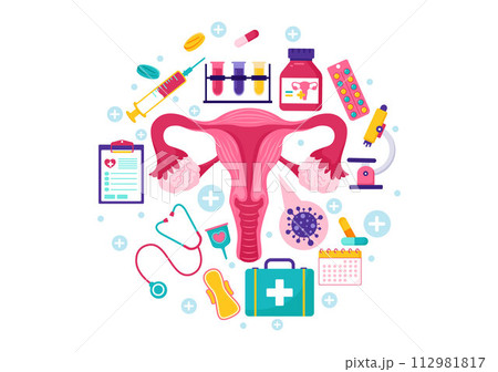 Endometriosis Vector Illustration with Condition the Endometrium Grows Outside the Uterine Wall in Women for Treatment in Flat Cartoon Background Endometriosis Vector Illustration with Condition the Endometrium Grows Outside the Uterine Wall in Women for Treatment in Flat Cartoon Background 112981817