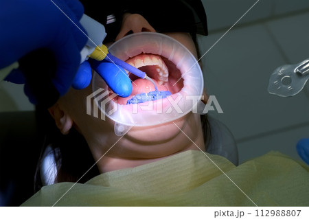 Dentist is applying blue acid on woman's teeth before installing veneers. Dentist is applying blue acid on woman's teeth before installing veneers. 112988807