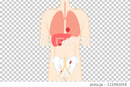 前立腺の医療イラスト、前立腺癌のステージ4 112992058