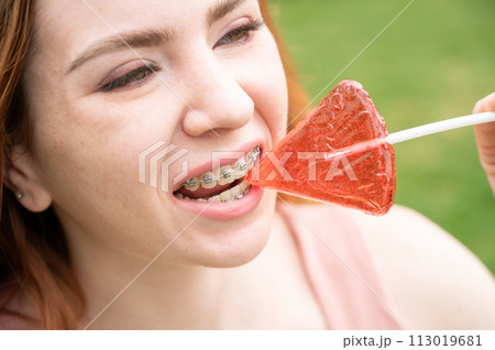 Beautiful young woman with braces on her teeth eats a watermelon-shaped lollipop outdoors. Beautiful young woman with braces on her teeth eats a watermelon-shaped lollipop outdoors. 113019681
