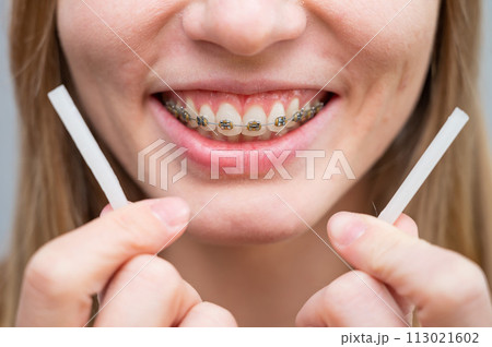 Close-up portrait of a woman with braces using special orthodontic wax. 113021602