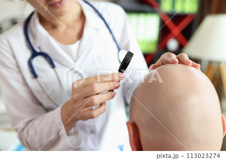 Female doctor looks at skin of bald patient through magnifying glass. 113023274