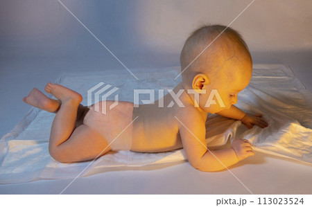 a baby with a hemangioma on his neck lies on a white background a baby with a hemangioma on his neck lies on a white background 113023524