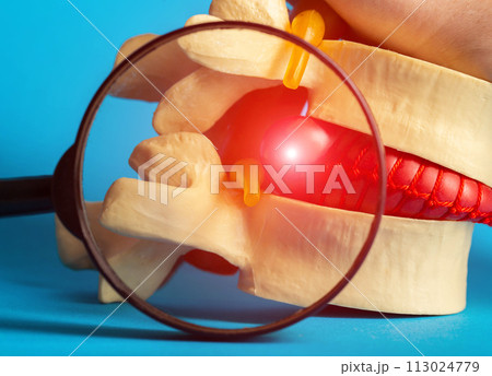 Inflamed red herniated disc of the spine under a magnifying glass. Concept for the treatment of spinal diseases, osteochondrosis and kyphosis, close-up Inflamed red herniated disc of the spine under a magnifying glass. Concept for the treatment of spinal diseases, osteochondrosis and kyphosis, close-up 113024779