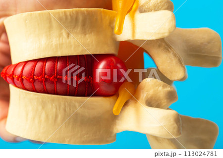 Convex red intervertebral disc herniation on a model of the spine. Treatment of problems and diseases of the spine. Orthopedics and vertebrology, close-up Convex red intervertebral disc herniation on a model of the spine. Treatment of problems and diseases of the spine. Orthopedics and vertebrology, close-up 113024781