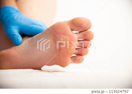 A doctor examines the foot of a person who has a large callus and a stem wart. Treatment and removal of warts and corns, close-up A doctor examines the foot of a person who has a large callus and a stem wart. Treatment and removal of warts and corns, close-up 113024797