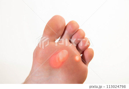 A person's foot has a large callus on its foot due to rubbing from uncomfortable shoes. Rod wart on the sole of the foot, close-up A person's foot has a large callus on its foot due to rubbing from uncomfortable shoes. Rod wart on the sole of the foot, close-up 113024798