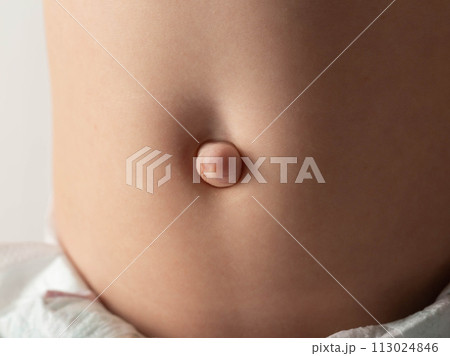 Umbilical hernia in a newborn baby on the stomach. Treatment of umbilical hernias in children without surgery, medical. Close-up Umbilical hernia in a newborn baby on the stomach. Treatment of umbilical hernias in children without surgery, medical. Close-up 113024846