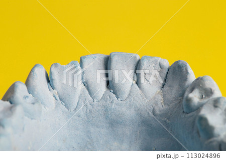 Blue plaster impression of a patient's dental jaw with crooked teeth and malocclusions on a yellow background. Manufacturing of braces to correct bite. View from above. Copy space for text Blue plaster impression of a patient's dental jaw with crooked teeth and malocclusions on a yellow background. Manufacturing of braces to correct bite. View from above. Copy space for text 113024896