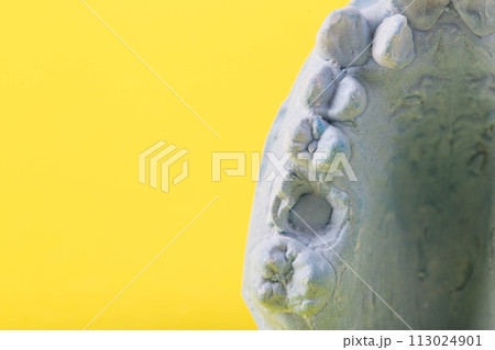 Blue plaster impression of a patient's dental jaw with crooked teeth and malocclusions on a yellow background. Manufacturing of braces to correct bite. View from above. Copy space for text 113024901