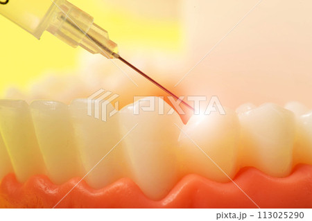 Injection of an anesthetic drug into the gum of a diseased tooth for treatment and surgery. Dental anesthesia in dentistry, freezing, macro. Copy space for text 113025290
