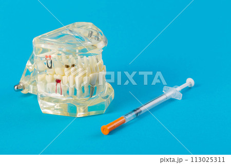 A syringe with anesthesia on a blue background next to a mock-up of a medical jaw. The concept of surgical operations on the gums and tooth extraction under anesthesia. Painkillers and freezing in A syringe with anesthesia on a blue background next to a mock-up of a medical jaw. The concept of surgical operations on the gums and tooth extraction under anesthesia. Painkillers and freezing in 113025311