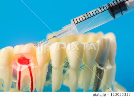 Injection of an anesthetic drug into the gum of a diseased tooth for treatment and surgery. Dental anesthesia in dentistry, freezing, macro. Copy space for text Injection of an anesthetic drug into the gum of a diseased tooth for treatment and surgery. Dental anesthesia in dentistry, freezing, macro. Copy space for text 113025313