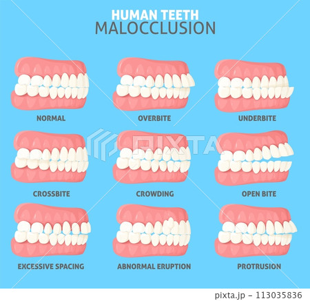 Malocclusion types side view dentist medical poster 113035836