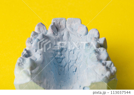 Blue plaster impression of a patient's dental jaw with crooked teeth and malocclusions on a yellow background. Manufacturing of braces to correct bite. View from above. Copy space for text Blue plaster impression of a patient's dental jaw with crooked teeth and malocclusions on a yellow background. Manufacturing of braces to correct bite. View from above. Copy space for text 113037544