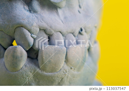 Blue plaster impression of the dental jaw of a patient with crooked teeth and malocclusions. Manufacturing of dentures and crowns based on orthodontic impressions, close-up Blue plaster impression of the dental jaw of a patient with crooked teeth and malocclusions. Manufacturing of dentures and crowns based on orthodontic impressions, close-up 113037547