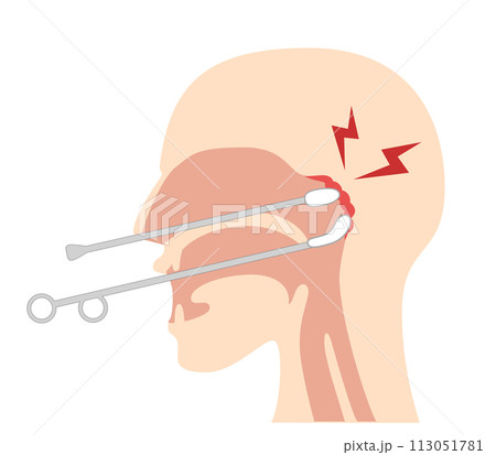 上咽頭擦過治療(Bスポット治療)のやり方と図解 上咽頭擦過治療(Bスポット治療)のやり方と図解 113051781