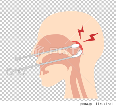 上咽頭擦過治療(Bスポット治療)のやり方と図解 上咽頭擦過治療(Bスポット治療)のやり方と図解 113051781