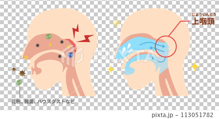 鼻うがいの効果とやり方　上咽頭を洗浄する方法 113051782