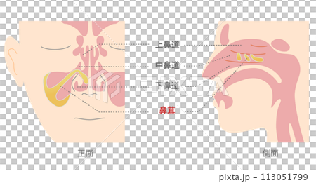 Illustration of polyps in the sinuses from the front and side Illustration of polyps in the sinuses from the front and side 113051799