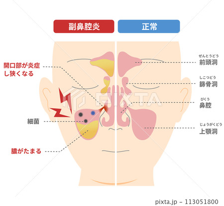 慢性副鼻腔炎が起こる仕組みと原因の比較図 113051800