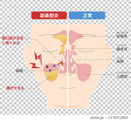 慢性副鼻腔炎が起こる仕組みと原因の比較図 113051800