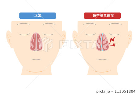 鼻中膈の変形によって起こる鼻中膈弯曲症のイラスト 鼻中膈の変形によって起こる鼻中膈弯曲症のイラスト 113051804