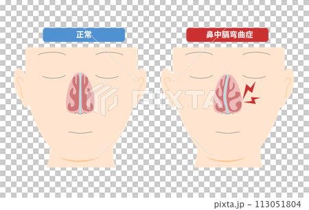 Illustration of midnasal curvature caused by deformation of the nasal midsection 113051804
