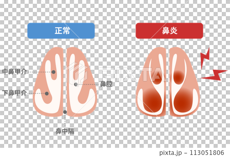 鼻炎時下鼻甲血管擴張，鼻塞 113051806