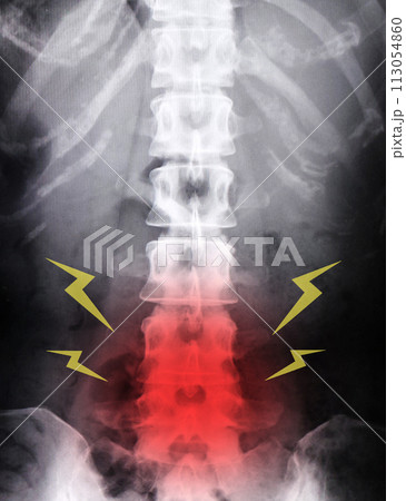 腰痛のレントゲン 113054860