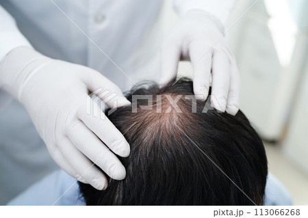 Doctor touch bold head in man, hair loss treatment health problem. 113066268
