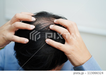 Bald head in man, hair loss treatment health problem. Bald head in man, hair loss treatment health problem. 113066324