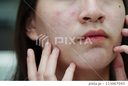 Acne pimple and scar on skin face, disorders of sebaceous glands, teenage girl skincare beauty problem. Acne pimple and scar on skin face, disorders of sebaceous glands, teenage girl skincare beauty problem. 113067043