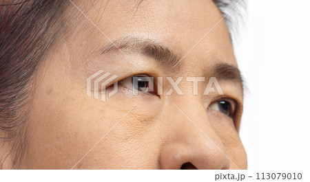 The ptosis or droopy eyelids in asian senior woman.. 113079010